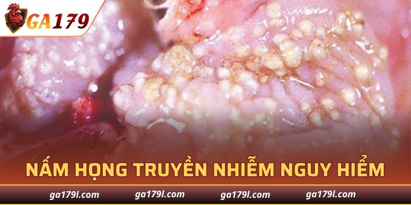Nấm họng là tình trạng truyền nhiễm nguy hiểm
